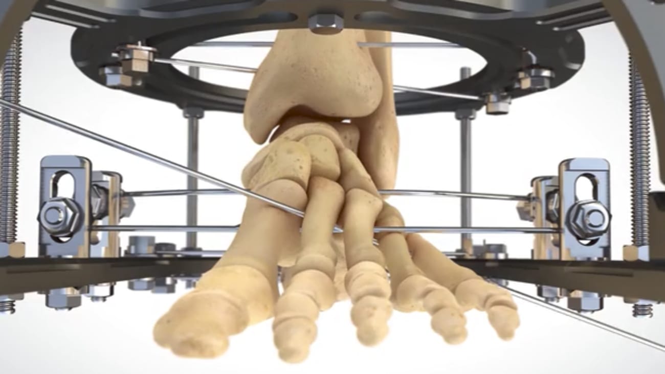 external fixation midfoot animation featuring salvation 014623 vlc external fixator