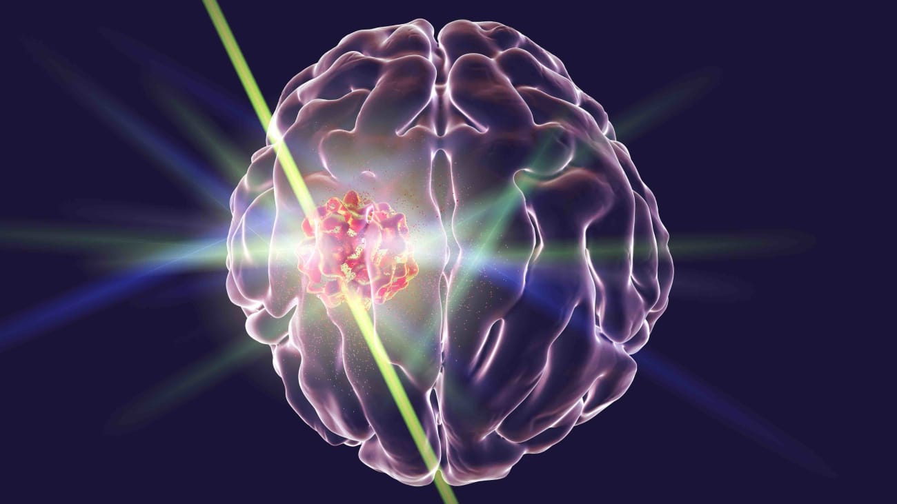 laser therapy for brain lesions brigham and women s physician