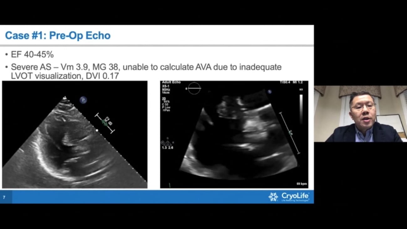 Avr Options For The Bicuspid Patient Case Based Discussion Cryolife