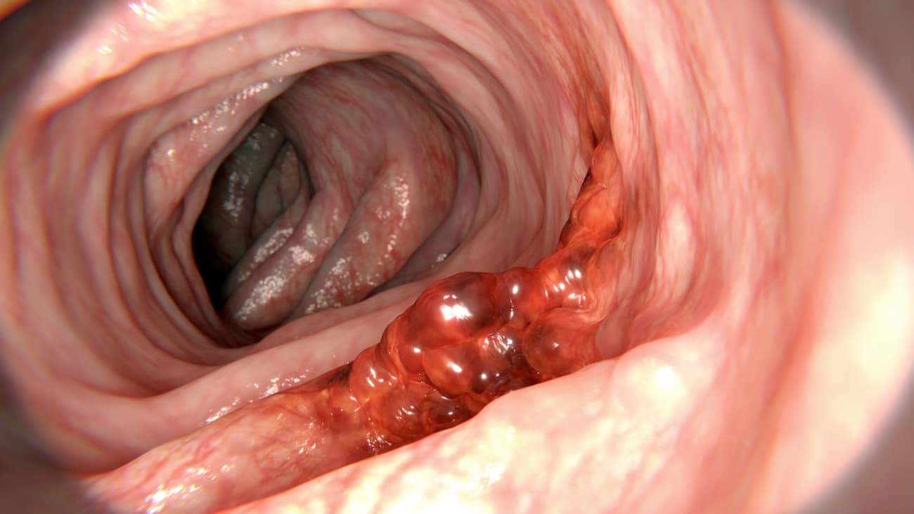 How to treat lip cancer How to treat lip cancer