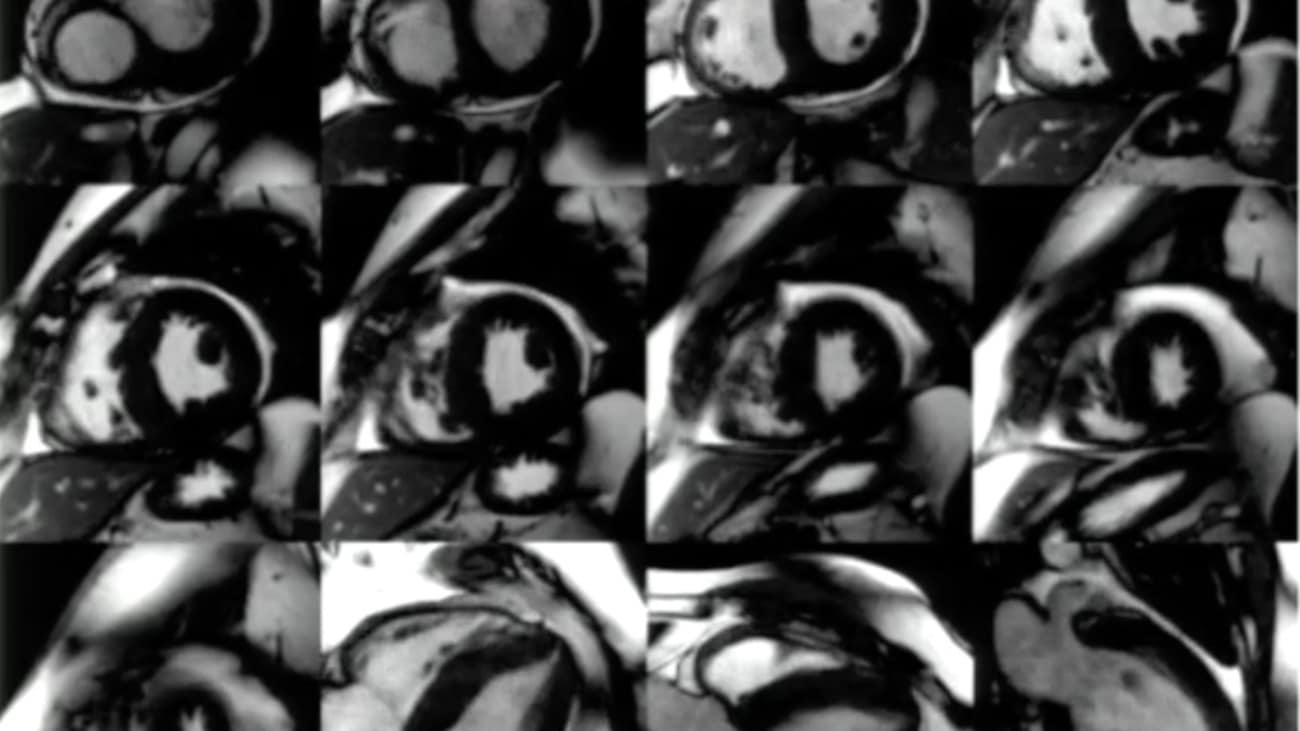 the role of cardiac mri in heart failure heart mri