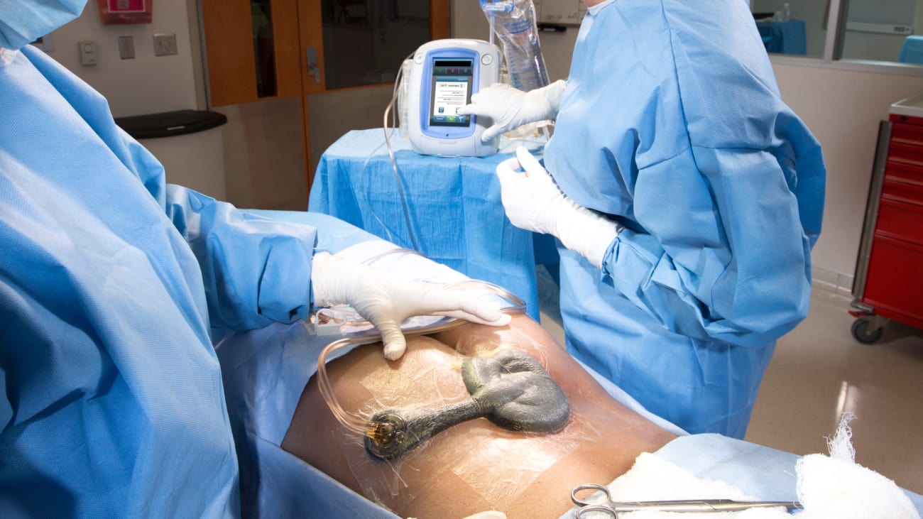 a spectrum of v a c therapy in the management of pressure ulcers