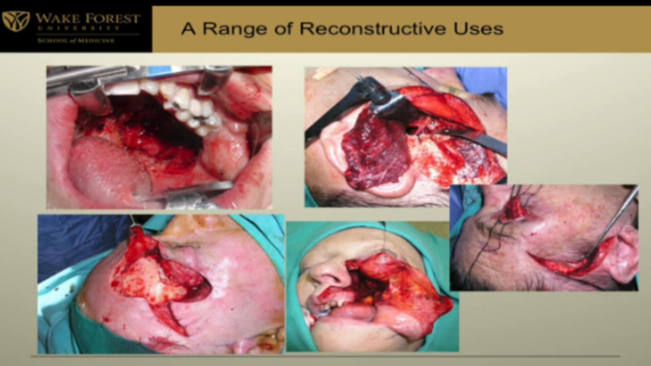 Ent Flap Surgery The Temporalis Flap In Otolaryngology Broadcastmed