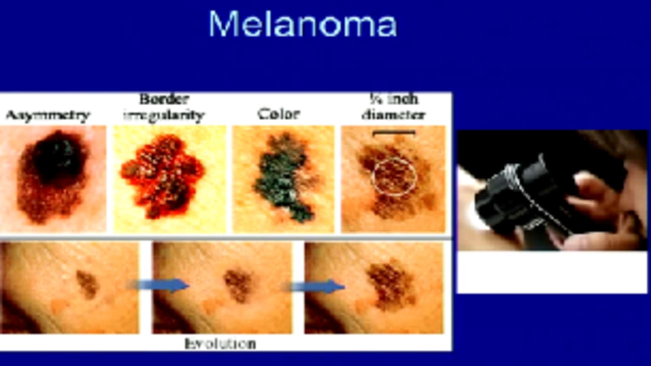 The Prevalence And Risk Factors Of Skin Cancer In Organ Transplant Recipients - 