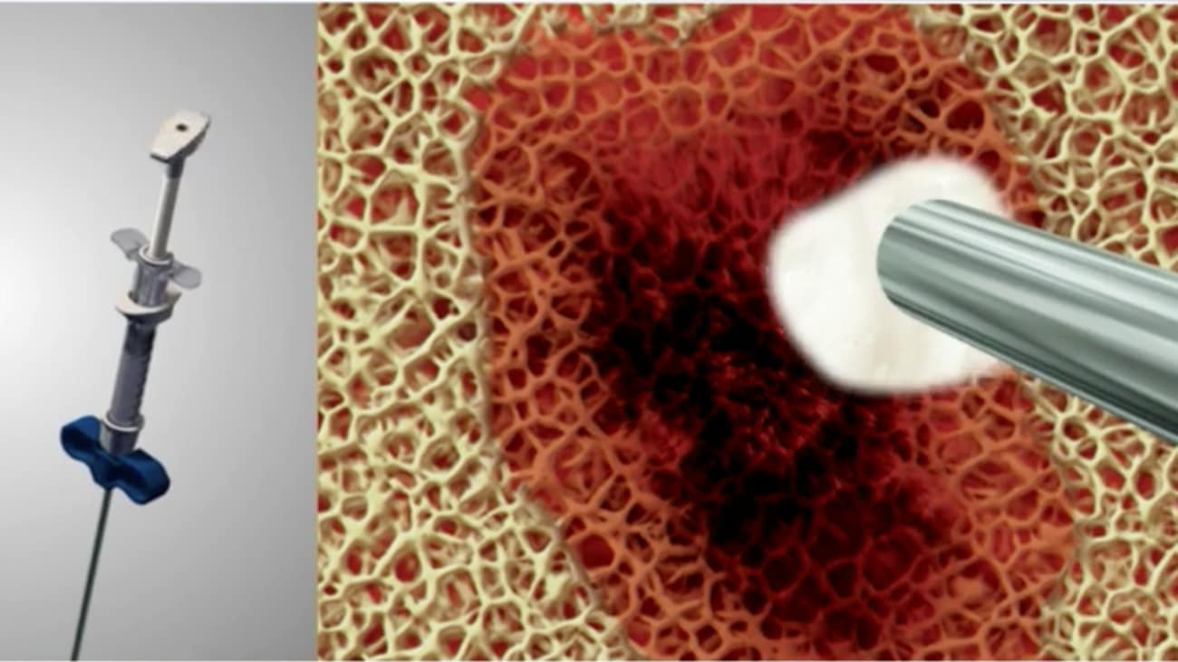 mechanism of actoion for ifactor bone graft