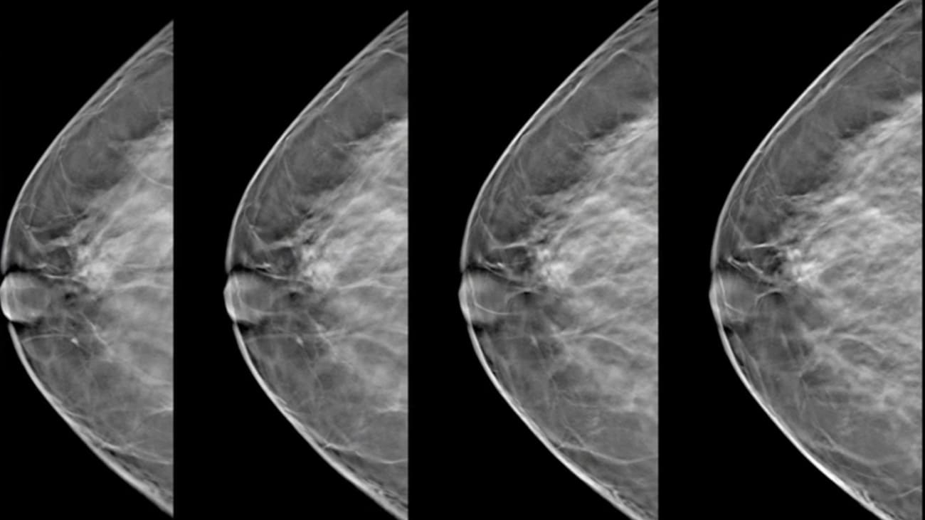 Breast 3d tomosynthesis image