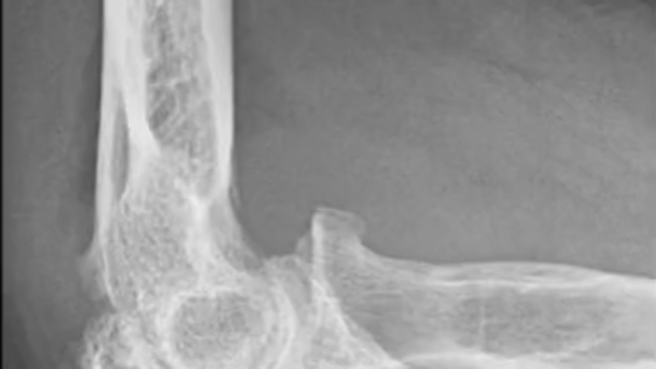 Elbow Arthroplasty featuring Latitude Surgical Technique Graham King