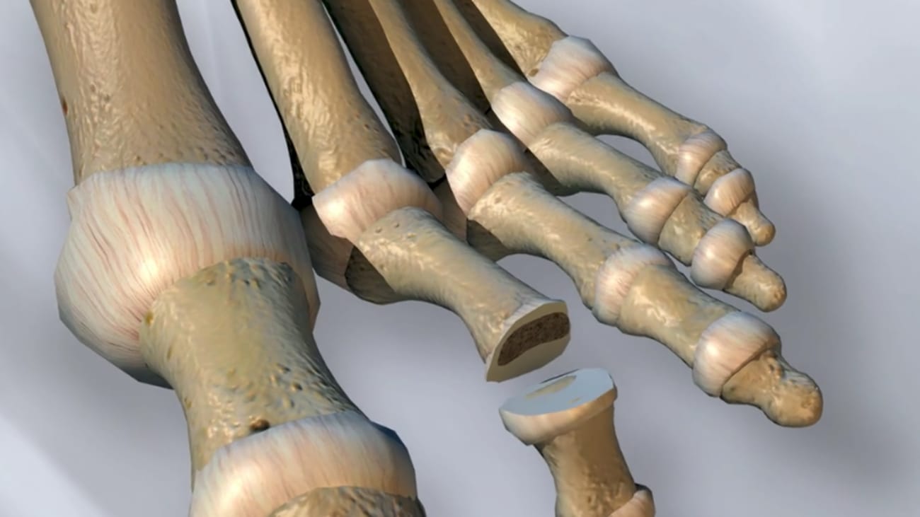 PHALINX™ Hammertoe Fixation System Surgical Technique Animation [011725