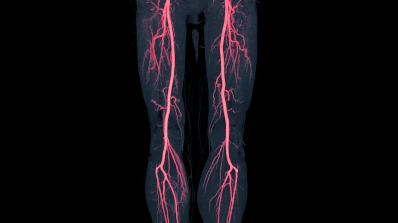 angiodynamics laser atherectomy