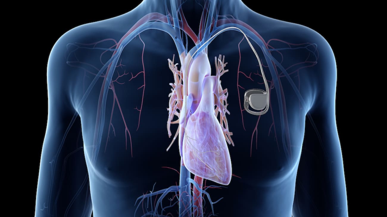 Current status of implantable loop recorders and leadless pacemaker