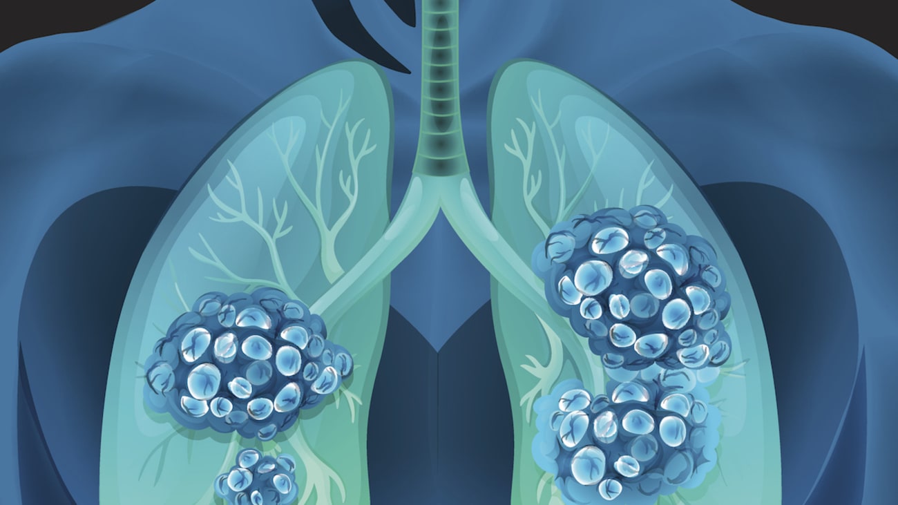 New RuleOut Test for Lung Cancer Increases Diagnostic