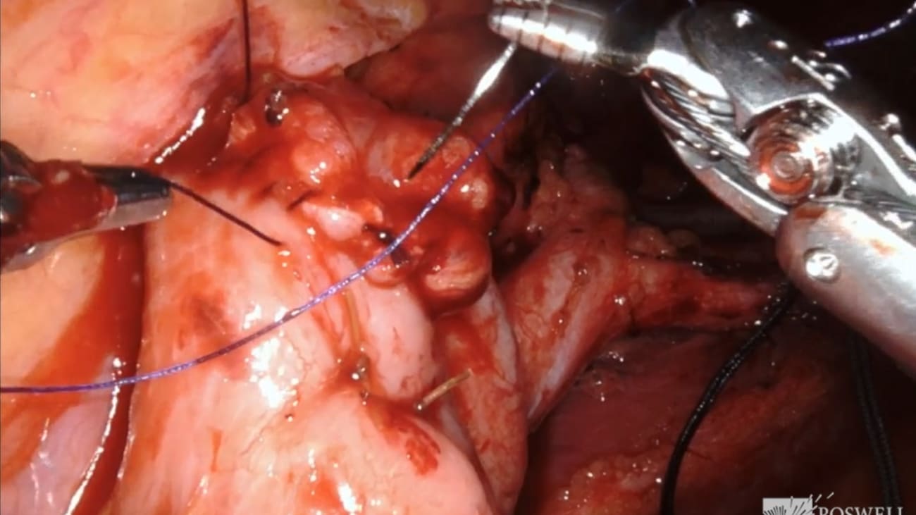 Day 2 Robot Assisted Radical Cystectomy With Pelvic Lymph Node 8876