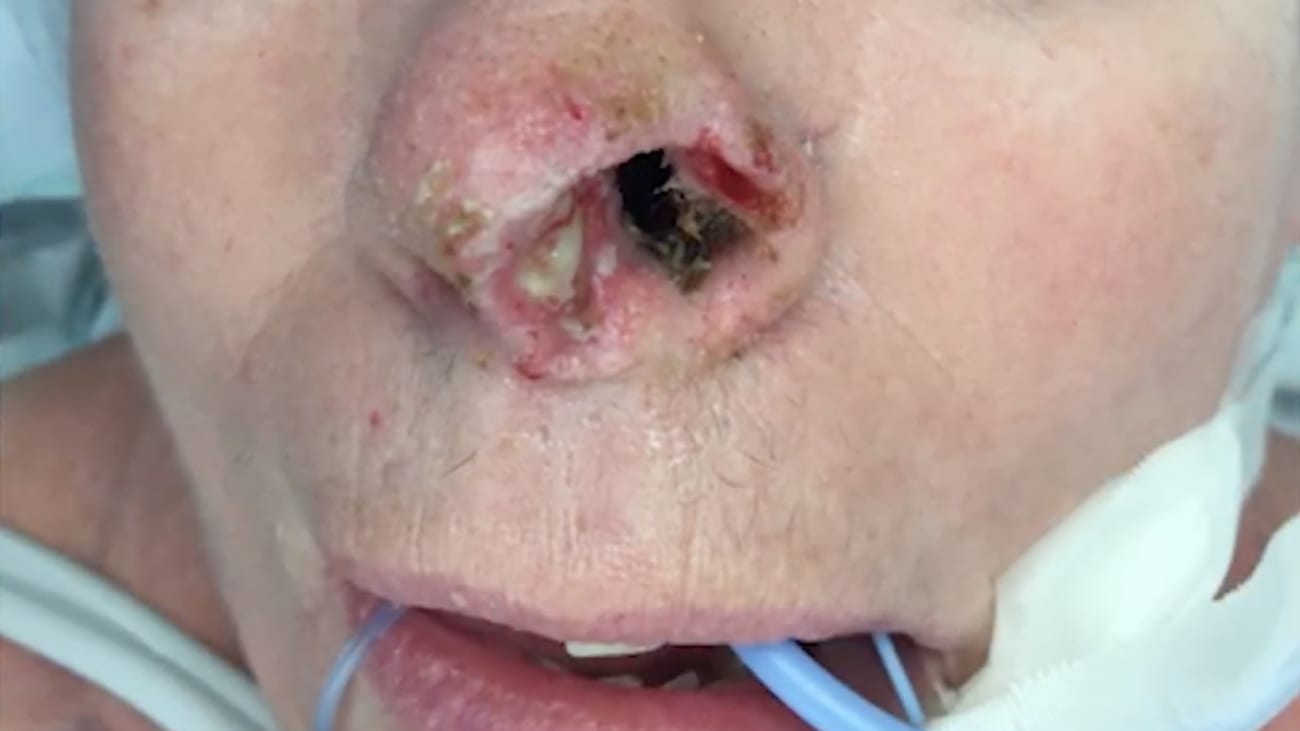 Complex Nasal Reconstruction for Merkel Cell Carcinoma - BroadcastMed