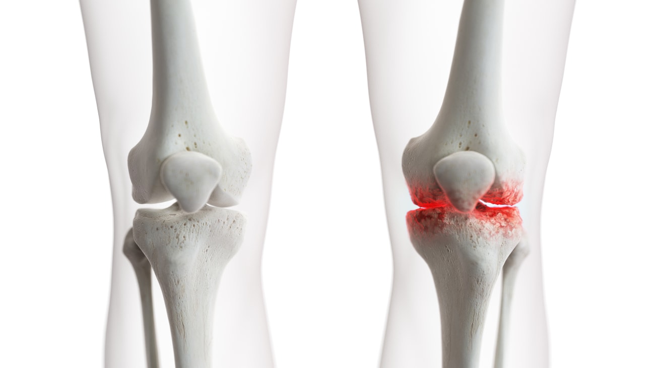 Knee Osteoarthritis Clinical Trial Ohio State Md Connect