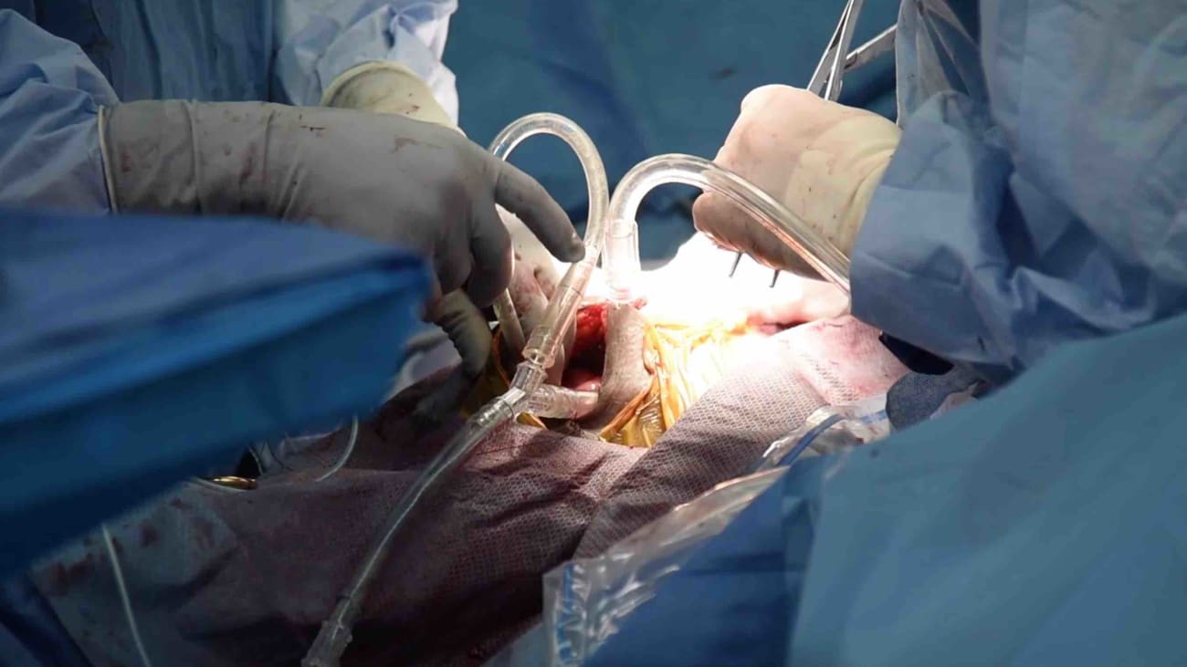 Hyperthermic Intraperitoneal Chemotherapy for Abdominal