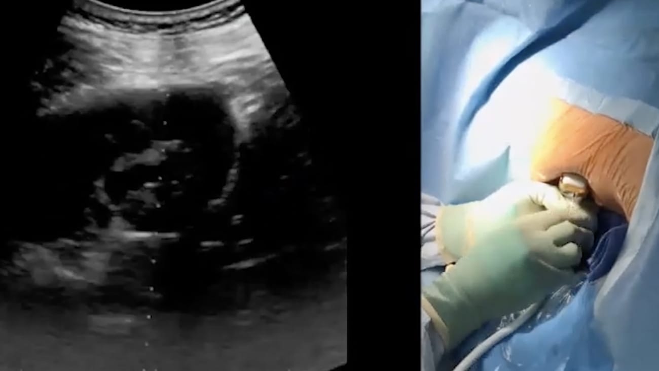 Ultrasound Guidance for Mini PCNL BroadcastMed