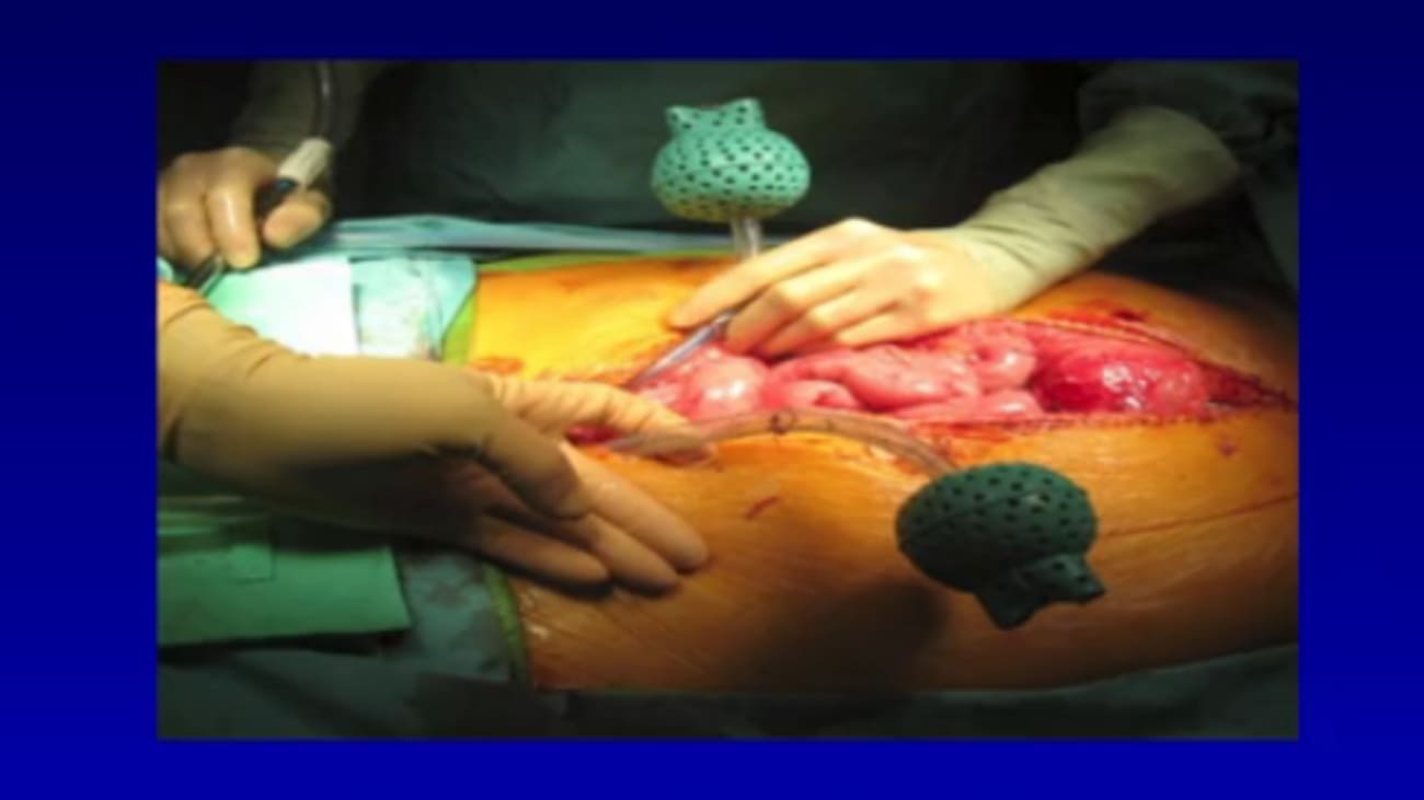 Cytoreduction (CRS) with Hyperthermic Intraperitoneal