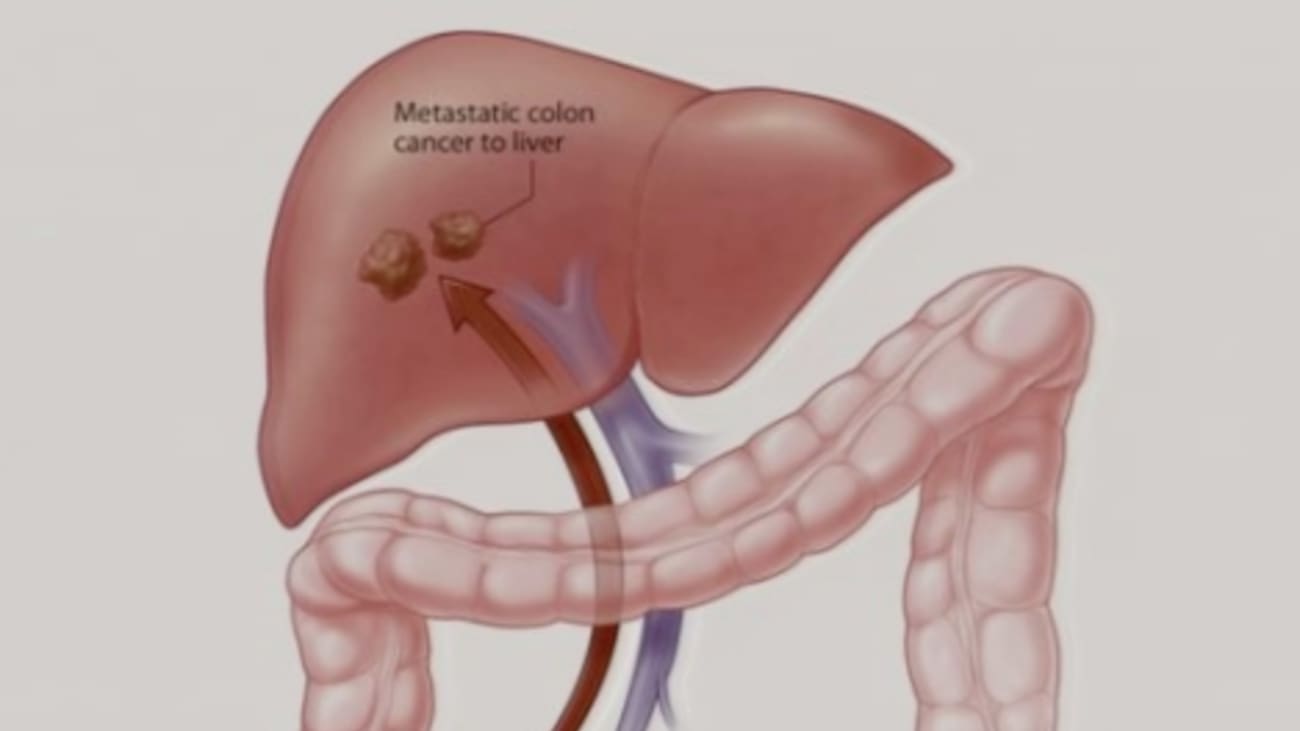 metastatic-colorectal-cancer-cancerwalls