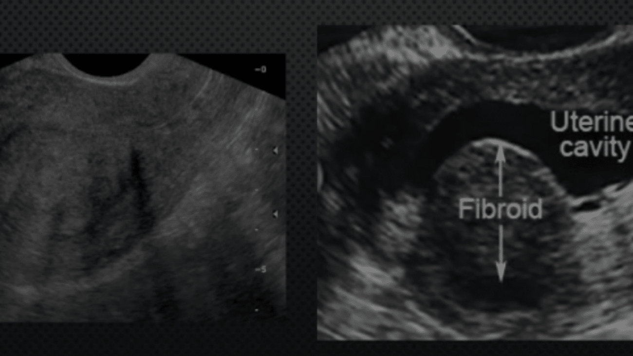 Case Studies Fibroids BroadcastMed case-studies-fibroids-broadcastmed