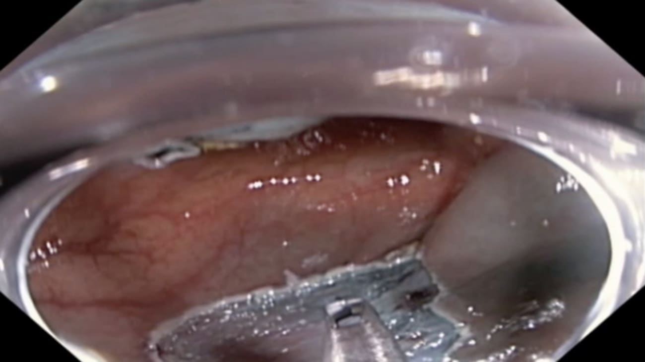 Colon Closure Tble Case Study Using Rotatable Clips for Defect Closure in the Colon, by ...