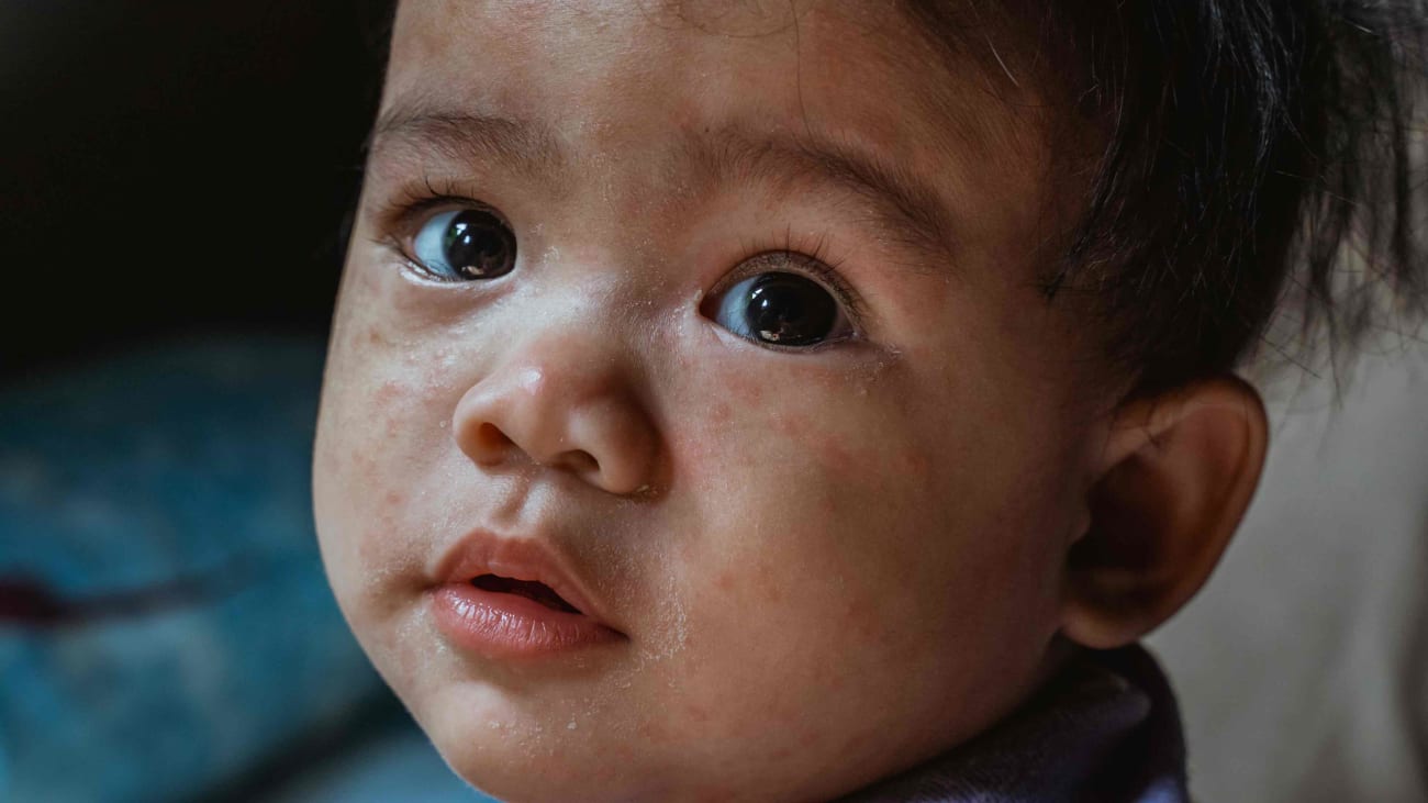 Name That Rash: A Pictorial Guide for Perplexed Pediatricians - UCSF ...