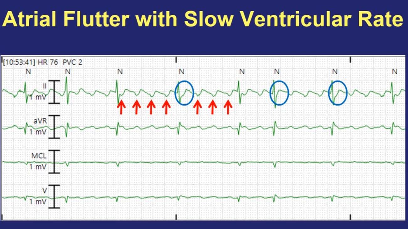 Telemetry Tips Part 1: Atrial Flutter and Atrial Tachycardia - BroadcastMed
