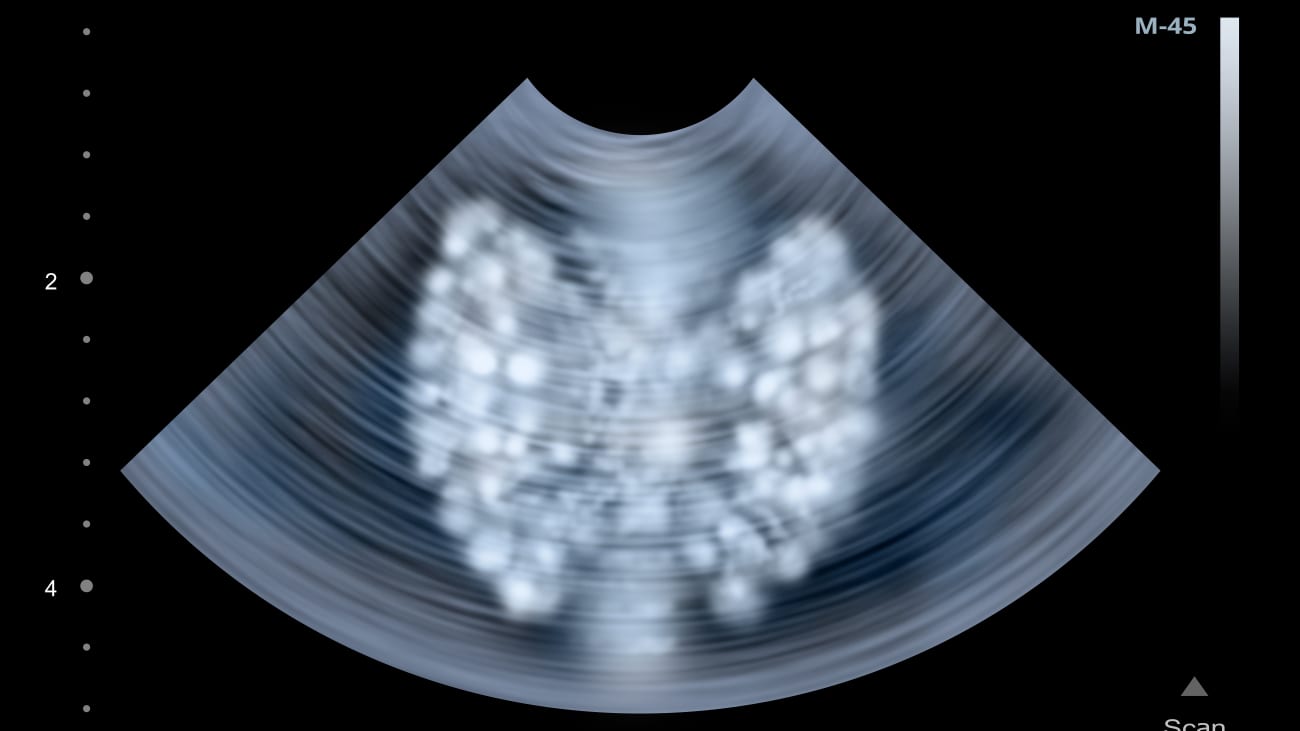Primary Hyperparathyroidism Radiology