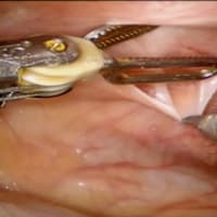 Robotic Management of Endometriosis