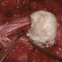 案例表示式:偶发肿瘤