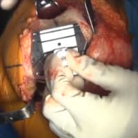 JOURNEYTM二轮BCS双稳健膝盖系统