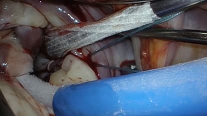 Mount Sinai Team Pioneers a Multidisciplinary Treatment of Mitral Valve Prolapse