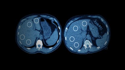 Lung Scans Reveal Elevated Incidence of Liver Disease Among 9/11 First Responders