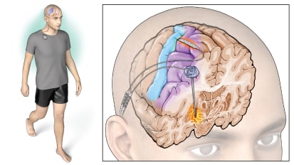 Brain Stimulation That Adapts to Parkinson’s Patients’ Every Step