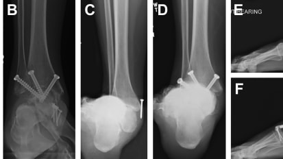 Johns Hopkins Orthopaedics Researchers Uncovering Demographic TAA Disparities 