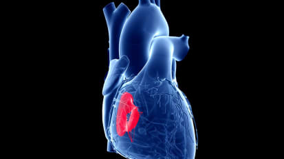 Smidt Heart Institute Physicians Advance Transcatheter Tricuspid Valve Replacement