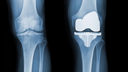 Can Total Joint Replacement Complication Rates Be Reduced?