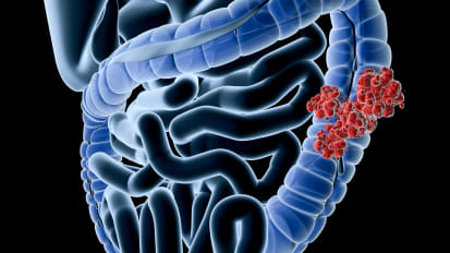 GASTROINTESTINAL CANCER PROGRAM