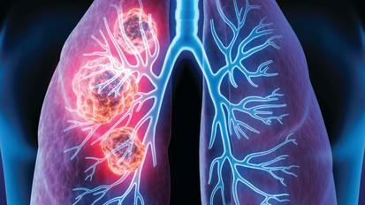 LUNG CANCER PROGRAM