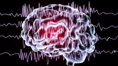 Deep Brain Stimulation for Epilepsy at Emory Brain Health Center