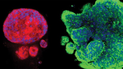 Clarifying the Mechanics of Brain Metastasis in Breast Cancer