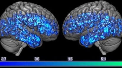 New Evidence Links Serotonin and Mild Cognitive Impairment