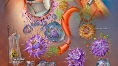 Incorporating Immunotherapy into the Standard of Care