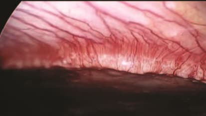 GORE<sup>®</sup> SYNECOR Biomaterial