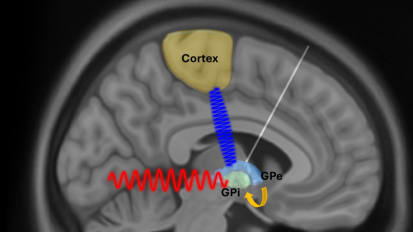 Brain activity discovery could transform Parkinson’s treatment