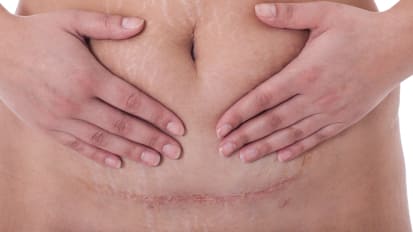 Reducing C-section Infection Rates