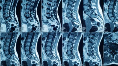 Minimally Invasive Spine Surgeries Offer Better Outcomes, Faster Recovery