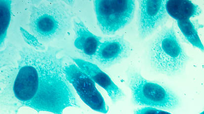 Next-Generation Robotic HiFU Emerges as Better Option for Some with Prostate Cancer