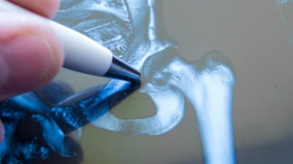 Comparison of cost and complications of primary total hip arthroplasty versus oncologic proximal femur replacement