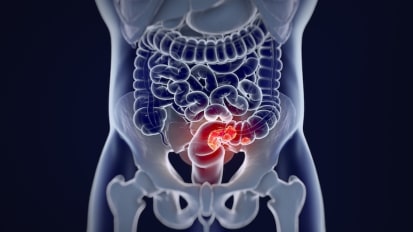 “45 is the New 50” as Age for Colorectal Cancer Screening is Lowered