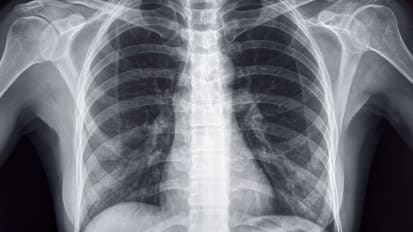 Role of Chest Imaging in Bronchoscopic Lung Volume Reduction Using Endobronchial Valves